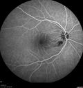 cilioretinal-artery-occl_kagro_022420_19.jpg