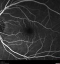 cilioretinal-artery-occl_kagro_022420_20.jpg