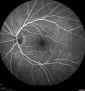 cilioretinal-artery-occl_kagro_022420_21.jpg