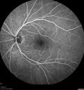 cilioretinal-artery-occl_kagro_022420_22.jpg