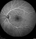 cilioretinal-artery-occl_kagro_022420_23.jpg