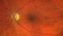 cilioretinalarteryocclusion_dosih_20191230_02.png