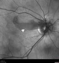 cilioretinalarteryocclusion_dosih_20191230_03.jpg