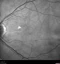 cilioretinalarteryocclusion_dosih_20191230_04~0.jpg