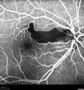 cilioretinalarteryocclusion_dosih_20191230_08.jpg