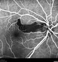 cilioretinalarteryocclusion_dosih_20191230_09.jpg