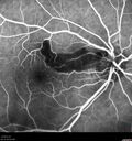 cilioretinalarteryocclusion_dosih_20191230_10.jpg