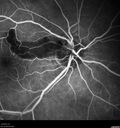 cilioretinalarteryocclusion_dosih_20191230_11.jpg