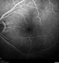 cilioretinalarteryocclusion_dosih_20191230_15.jpg