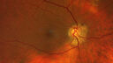 coneDystrophy_CRX_112425_01.jpg