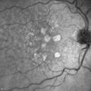 confluentDrusen_lipa1_03.jpg