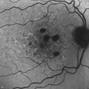 confluentDrusen_lipa1_05.jpg