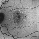 confluentDrusen_lipa1_06.jpg