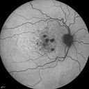 confluentDrusen_lipa1_07.jpg