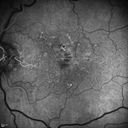 confluentDrusen_lipa1_11.jpg