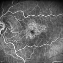 confluentDrusen_lipa1_13.jpg
