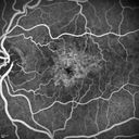 confluentDrusen_lipa1_15.jpg