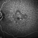 confluentDrusen_lipa1_16.jpg