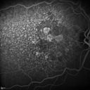 confluentDrusen_lipa1_19.jpg