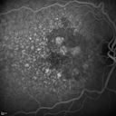 confluentDrusen_lipa1_20.jpg