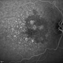 confluentDrusen_lipa1_21.jpg