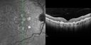 confluentDrusen_lipa2_6molater_27.jpg