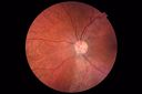 csr-OS-asymptomatic-goodva_28629.JPG