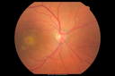 csr_fibrin21_mada_050117_02.png