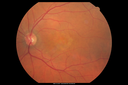 csr_fibrin21_mada_050117_03.png