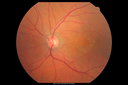 csr_fibrin21_mada_050117_04.png