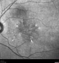 csr_fibrin21_mada_050117_10.jpg