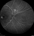 csr_fibrin21_mada_050117_21.jpg