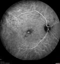 csr_fibrin21_mada_050117_31.jpg