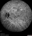 csr_fibrin21_mada_050117_34.jpg