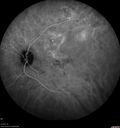 csr_fibrin21_mada_050117_35.jpg