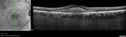 csr_fibrin2_mada_052217_01.jpg