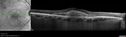 csr_fibrin2_mada_052217_02.jpg