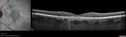 csr_fibrin2_mada_52217__000.jpg