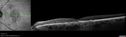 csr_fibrin2_mada_52217__001.jpg