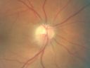 daionodchoroidalischemia_mani02.jpg