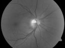 daionodchoroidalischemia_mani03.jpg