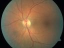 daionodchoroidalischemia_mani04.jpg