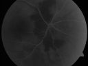 daionodchoroidalischemia_mani05.jpg