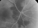 daionodchoroidalischemia_mani06.jpg