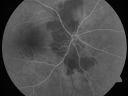 daionodchoroidalischemia_mani07.jpg