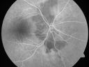daionodchoroidalischemia_mani08.jpg