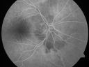 daionodchoroidalischemia_mani10.jpg