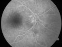 daionodchoroidalischemia_mani12.jpg