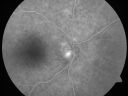 daionodchoroidalischemia_mani14.jpg