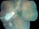 diabeticfibrosistrd_zeis01.jpg